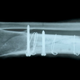 Illustration for article titled Implantable Sensors Will Keep Wireless Tabs on Mending Bones